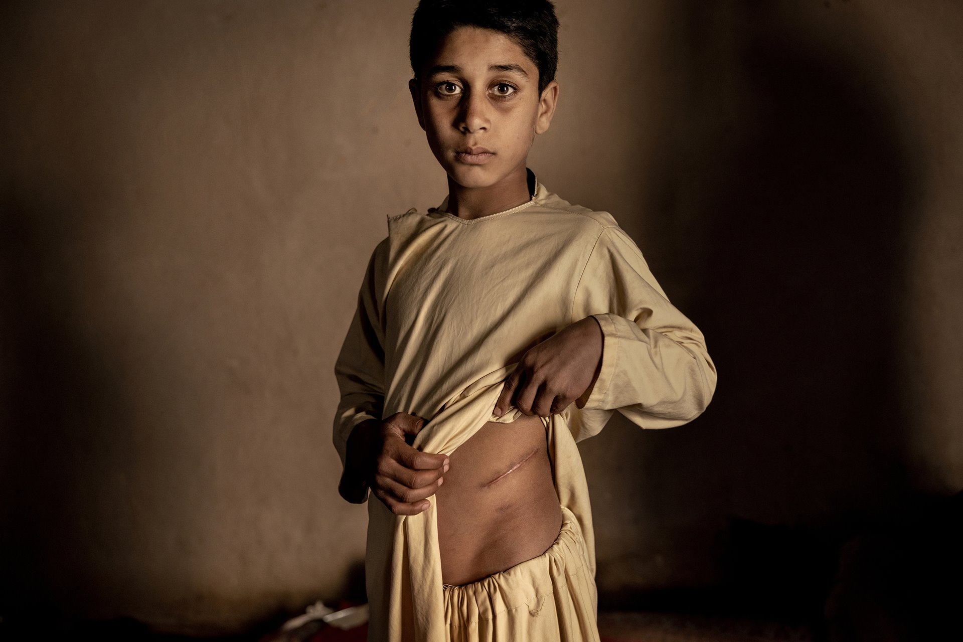 <p>Unable to afford food for the family, the parents of Khalil Ahmad (15) decided to sell his kidney for US$3,500. After the operation, Khalil suffers chronic pain and no longer has the strength for football and cricket. The lack of jobs and the threat of starvation has led to a dramatic increase in the illegal organ trade. Herat, Afghanistan.</p>
